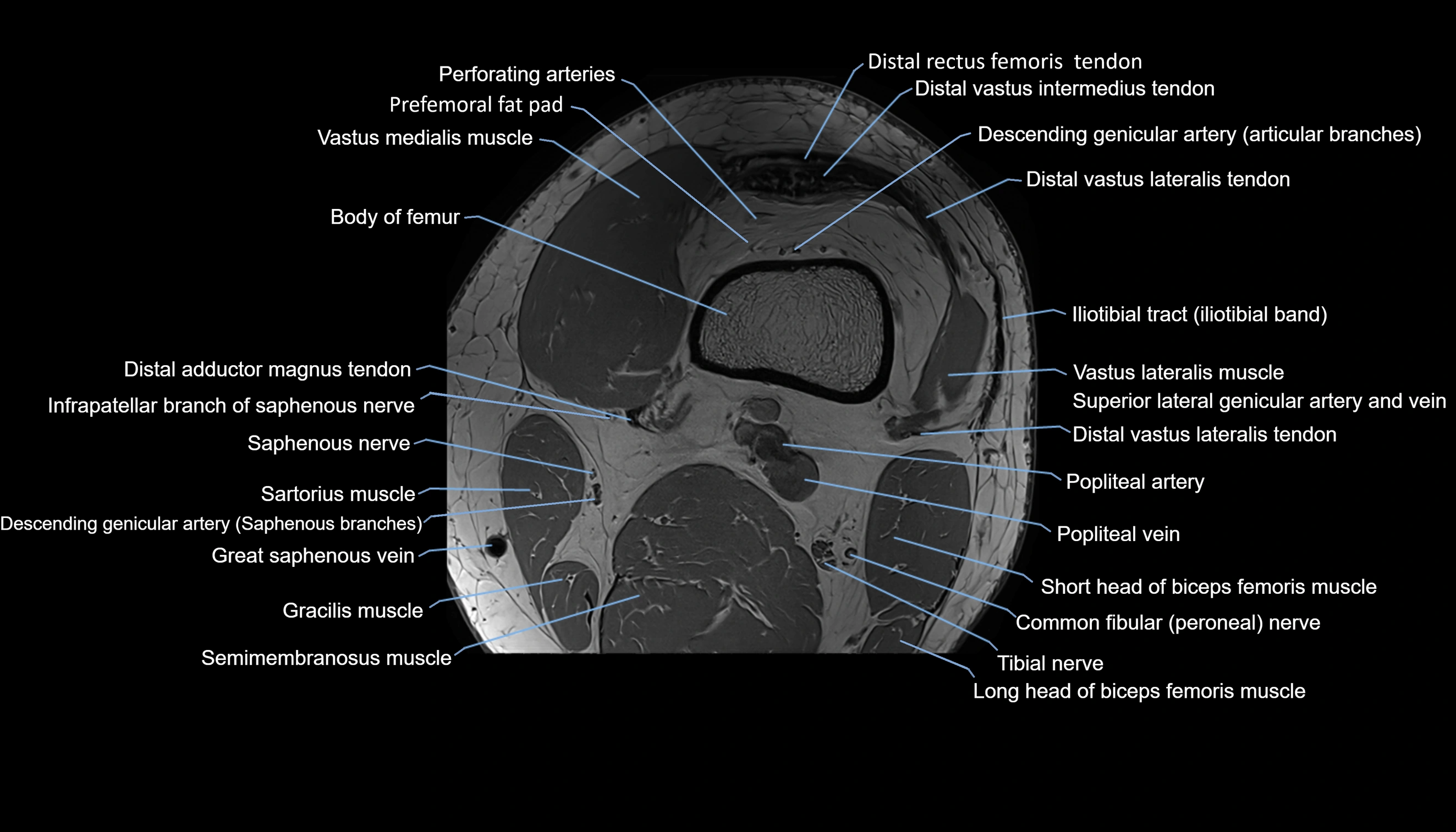MRI knee  axial cross sectional anatomy 3T radiology  image-img-00001-00002.webp